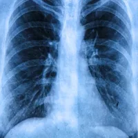 Zystische Fibrose