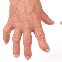 Rheumatoide Arthritis