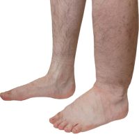 Gefäß- und Lymphkrankheiten