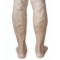 Krampfaderbehandlung