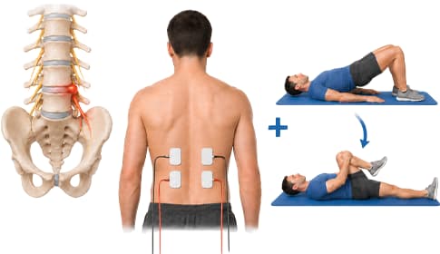 Elektrostimulation und Physiotherapie in der Rehabilitation bei Bandscheibenvorfall