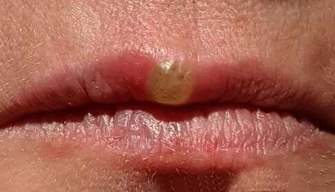 Lippenherpes Softlaser-Behandlung – Fallstudie mit Bildern
