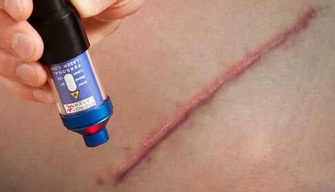 Softlaser-Behandlung von Narben und Keloiden – Anleitung für Zuhause