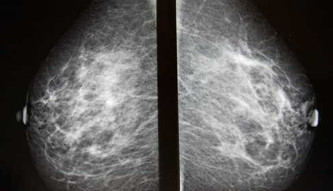 Mammographie – was Sie wissen müssen