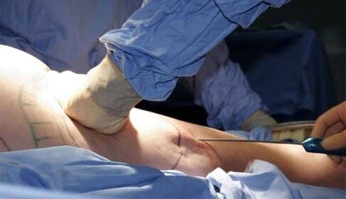 Fettabsaugung – was man wissen muss