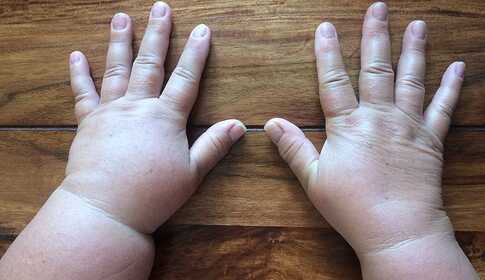 Behandlung des Lymphödems zu Hause
