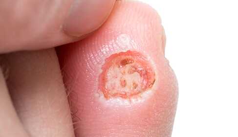 Diabetischer Fuß – was kannst du zur Vorbeugung tun?