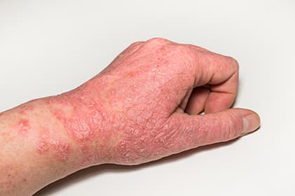 Dermatologische Probleme und Salztherapie – Ergänzende Behandlung bei Ekzem und Psoriasis