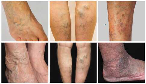 Unterschenkelgeschwür – mit Muskelstimulation zur Heilung