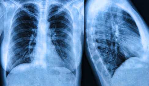 Wodurch kann ein Schatten in der Lunge entstehen? Die Thorax-Röntgenuntersuchung
