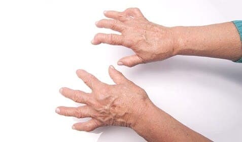 Rheumatoide Arthritis, eine der schwersten Erkrankungen des Bewegungsapparates