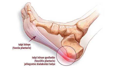 Entzündung der Plantarfaszie, also Plantarfasziitis
