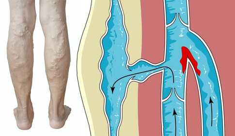 Thrombose – wenn deine Vene verstopft