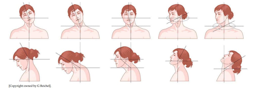 Torticollis - Richtungen des schiefen Halses