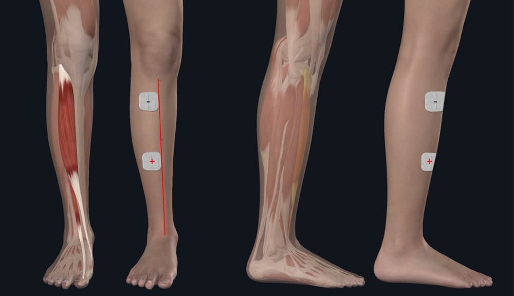 Elektrodenplatzierungspunkte bei Peroneus‑Parese