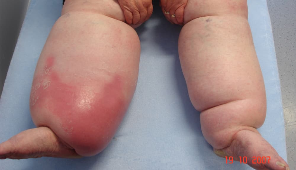 Erysipel (Orbánc), bakterielle Hautinfektion