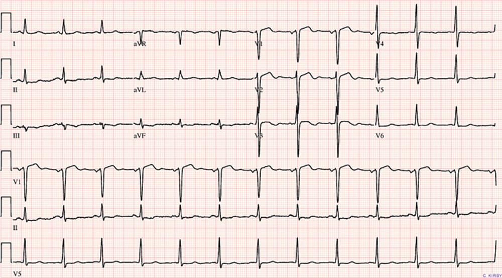 EKG-elektrokardiogram-felvetel-2.jpg