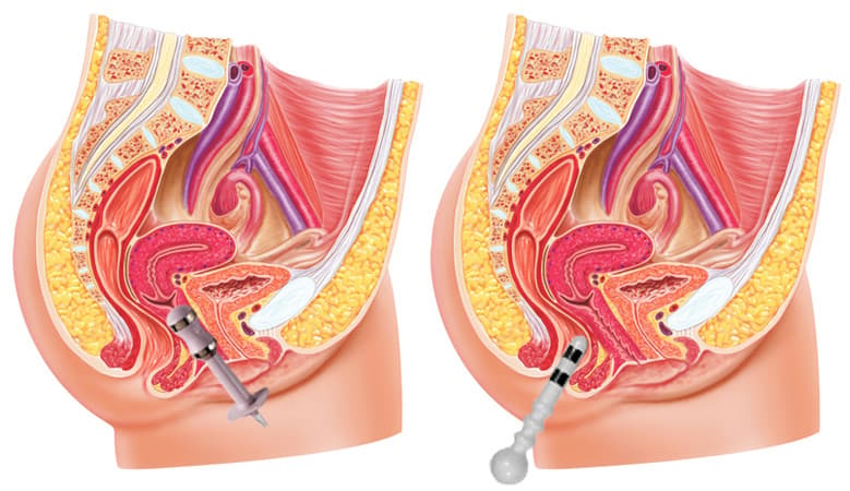 Inkontinenzbehandlung – Vaginal- und Rektalsonden-Position