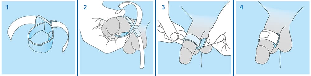 Anwendung des Medintim Prosecca-Bandes