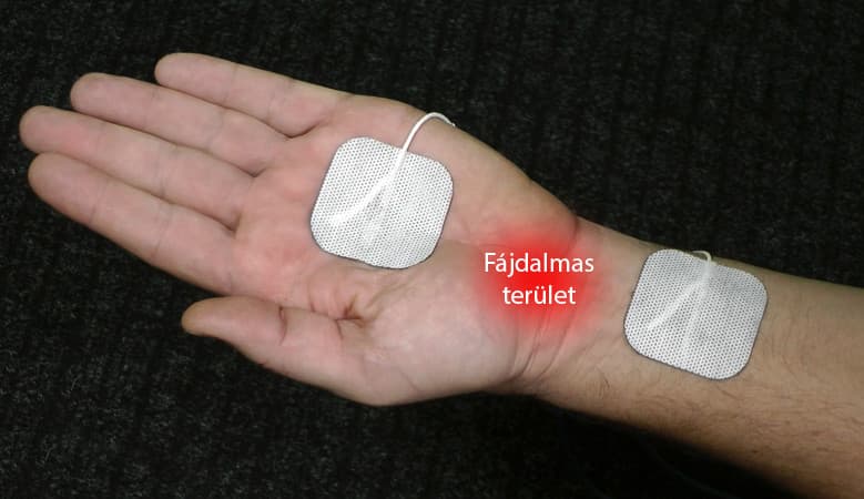 Elektrodenplatzierung bei Handgelenkschmerzen
