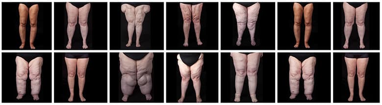 Lipoödem - Lymphödem