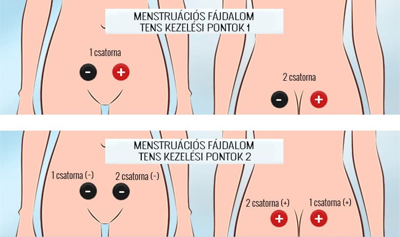 Behandlungspunkte bei Menstruationskrämpfen mit TENS, Behandlungsstellen