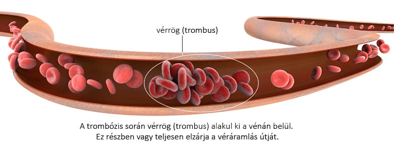Entstehung eines Thrombus - Ablauf