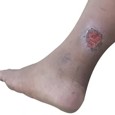 Hilfsmittel zur Behandlung von Unterschenkelgeschwüren