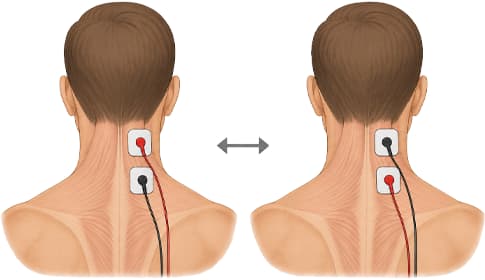 Elektrodenpolarität in der Elektrotherapie – wann zählt sie, wann nicht?